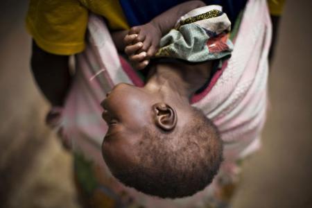  Un niño gravemente desnutrido cuelga de la espalda de su madre en Rutshuru, Congo. 