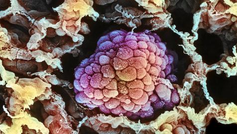 Imagen microscópica de un tumor durante su proceso de expansión (foto: Ansa)