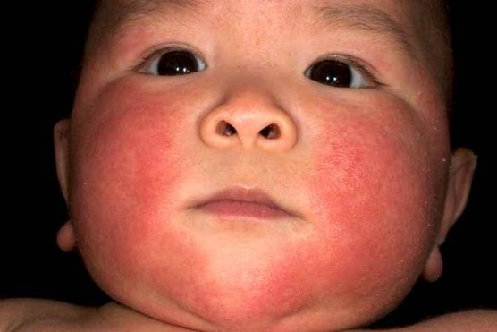 Alergias tempranas