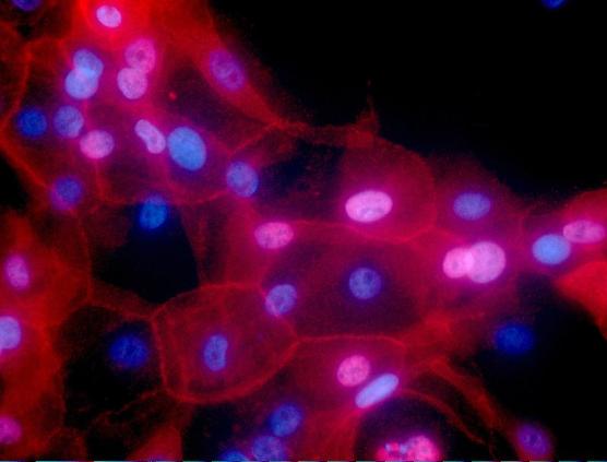 Células de cáncer de mama.