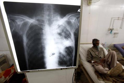 Un paciente afectado de tuberculosis (foto: ANSA)