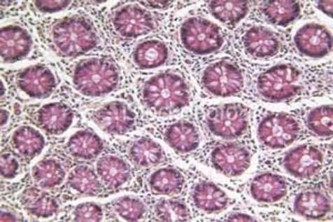 Células cancerígenas bajo la poderosa lente de un microscopio de avanzada (foto: Ansa)