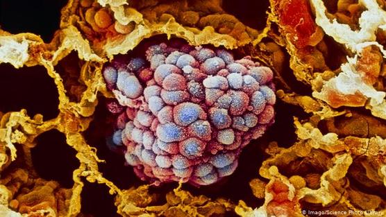 Imagen de un tumor localizado en un pulmón con cáncer.