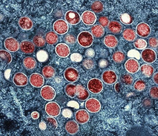 Imagen de NIAID muestra una micrografía electrónica de partículas de viruela del simio (rojas) 